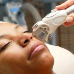 laser for dark skin