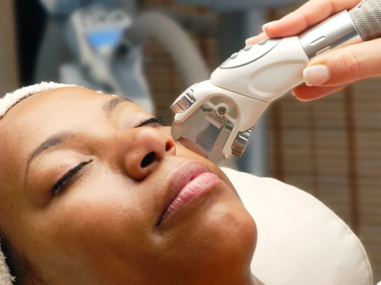 laser for dark skin